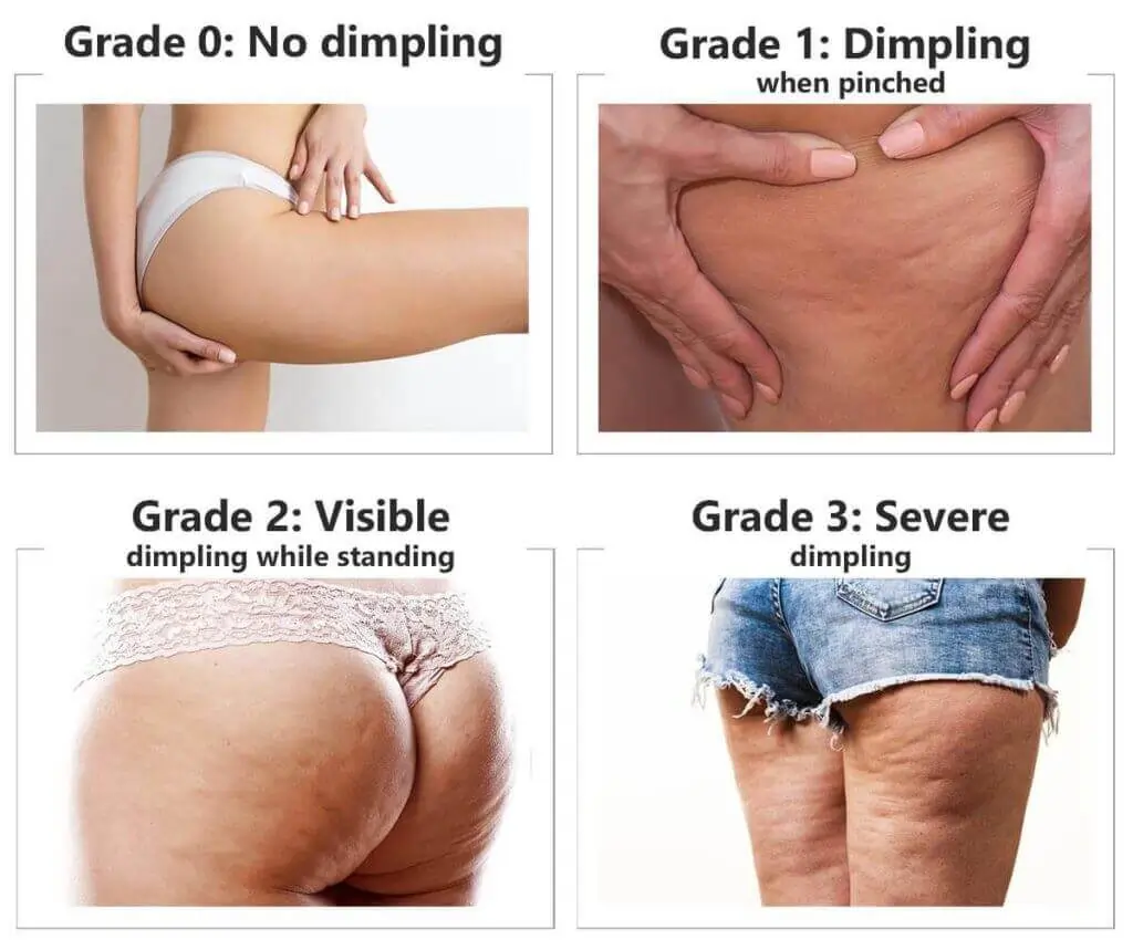 Representation of the stages of cellulite development Sevenoaks